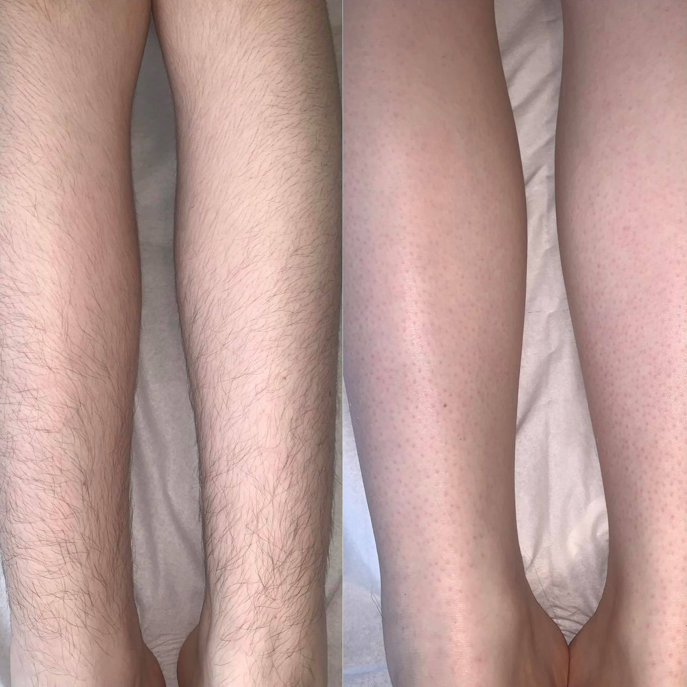 Permanent Hair Removal in 8 Weeks